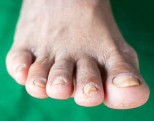 Treating fungal toenails is our job!