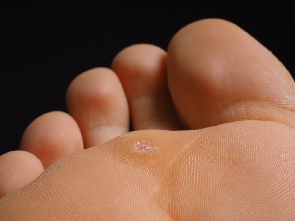 Plantar warts on the bottom of a foot.