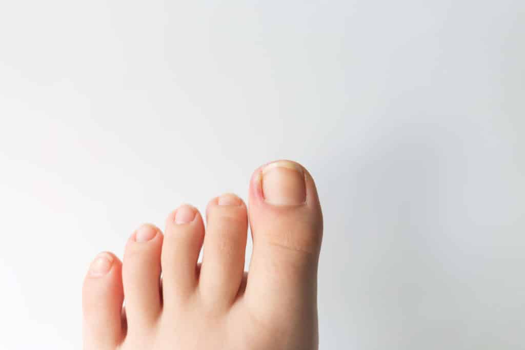 ingrown toenail on a child's foot, medical issue, discomfort.